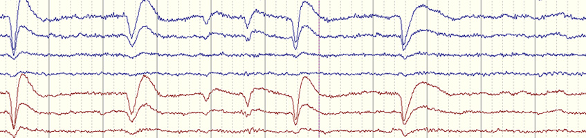 Grafische Darstellung einer EEG-Aufzeichnung